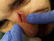 nariz rota asistencia medico San Jose